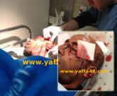 يافا: إصابة خطيرة للشاب حسن أصرف اثر إعتداء متطرفين يهود عليه فجر اليوم